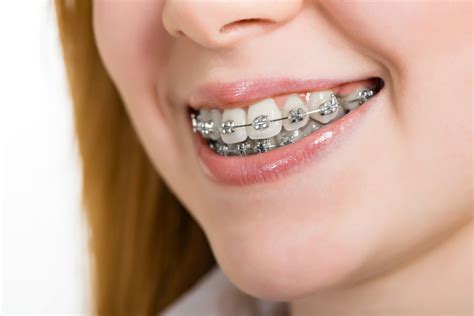 diferencia entre brackets de porcelana y metalicos|Diferencia entre brackets metálicos y de porcelana.